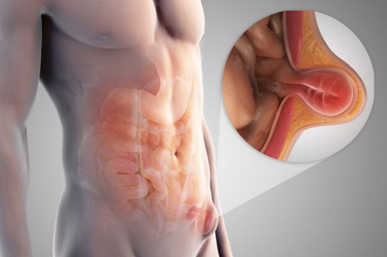 Hernia Clinic - Cirurgia Geral e Digestiva - Perguntas e respostas - HÉRNIA  INGUINAL Hérnias inguinais ou na virilha, ocorrem devido à fraqueza  muscular na parte inferior da parede abdominal, na área